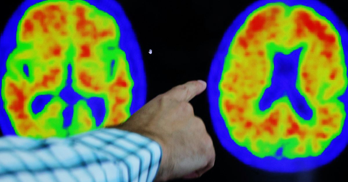 Eli Lilly's experimental drug shows promising results in slowing Alzheimer's progression.