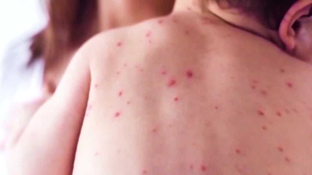 Featured image for Measles Outbreak in South Carolina Expands with Nearly 100 New Cases