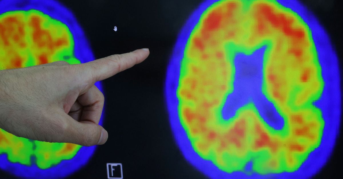 Featured image for US Government Invests $300 Million in Alzheimer's Research Database