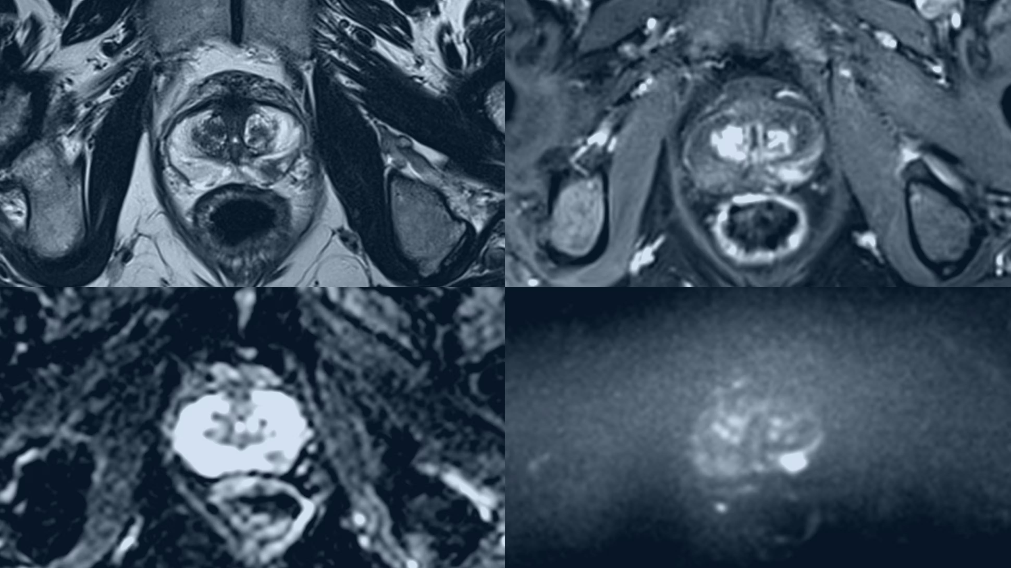 Featured image for Innovative Shorter MRI Scans Promise Faster, Cost-Effective Prostate Cancer Detection