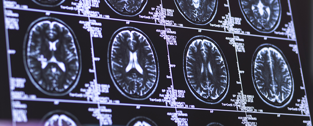 "Discovery: Gene Variant Offers Strong Protection Against Alzheimer's Disease"