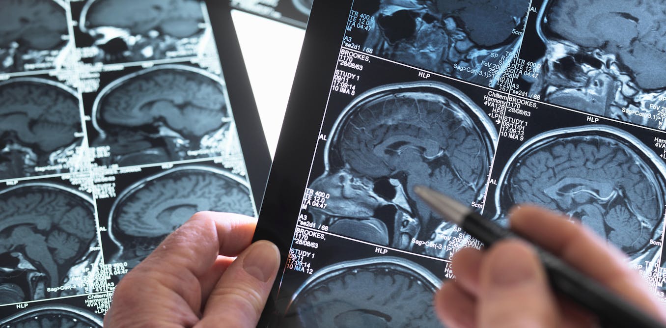 Featured image for "Uncovering the Crucial Link: Middle-Aged Brain Changes and Dementia Risk"