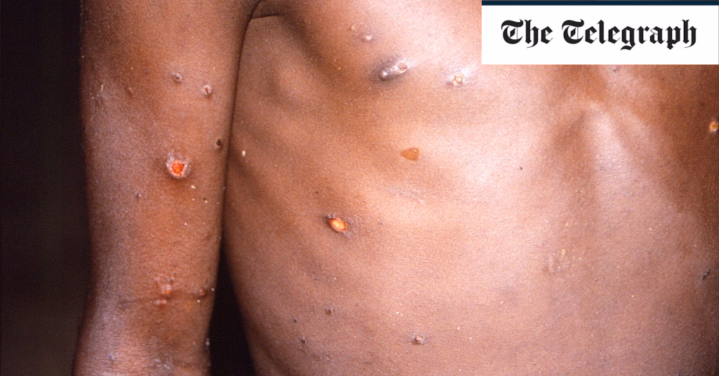 Featured image for "Dangerous MPOX Outbreak Accelerates Among Children in DRC"