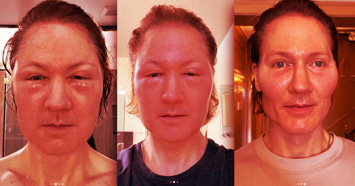 Featured image for Biohacker's Anti-Aging Experiment Leads to Shocking Facial Reaction