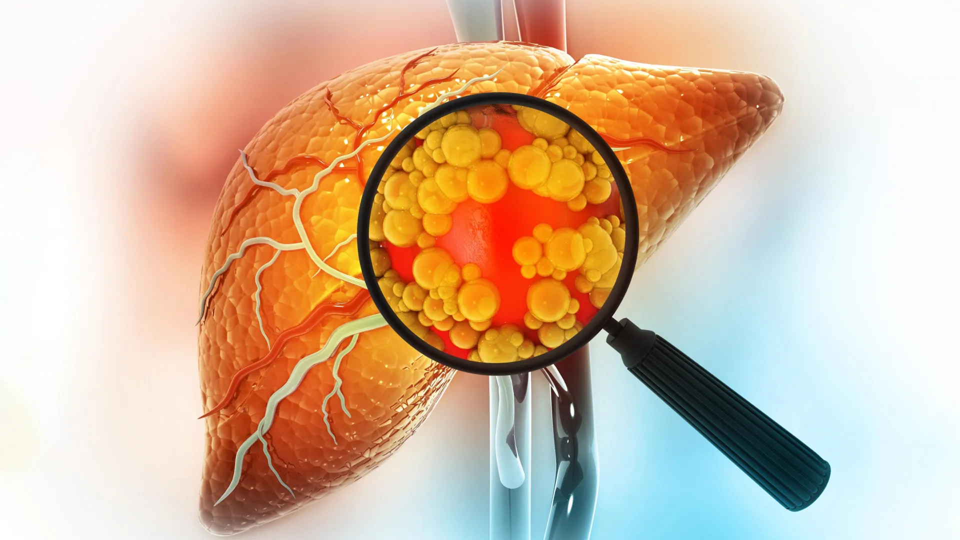 Featured image for Study Uncovers Key Factors Behind Fatty Liver Disease Mortality