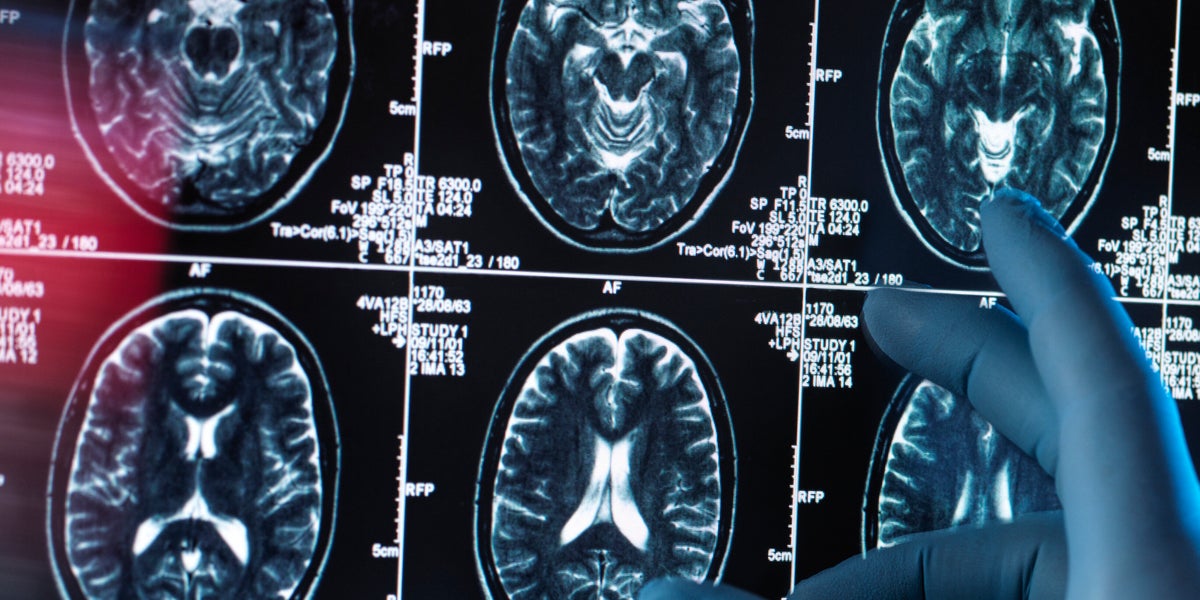 Featured image for Researchers Identify Two New Dementia Risk Factors