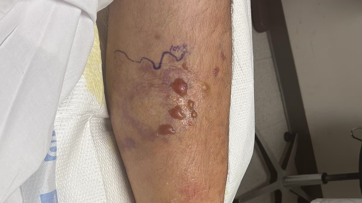 Featured image for Flesh-Eating Bacteria Outbreaks Rise in Coastal Areas, Authorities Warn