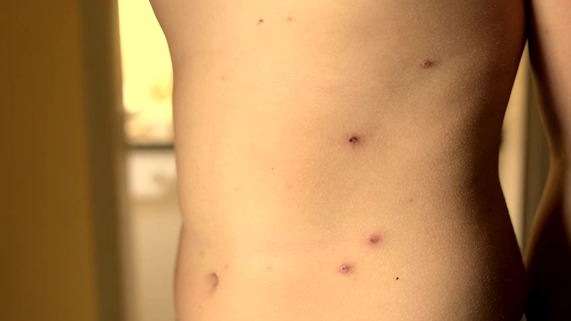 "Rising Measles Cases Prompt Vaccine Effectiveness Inquiry"