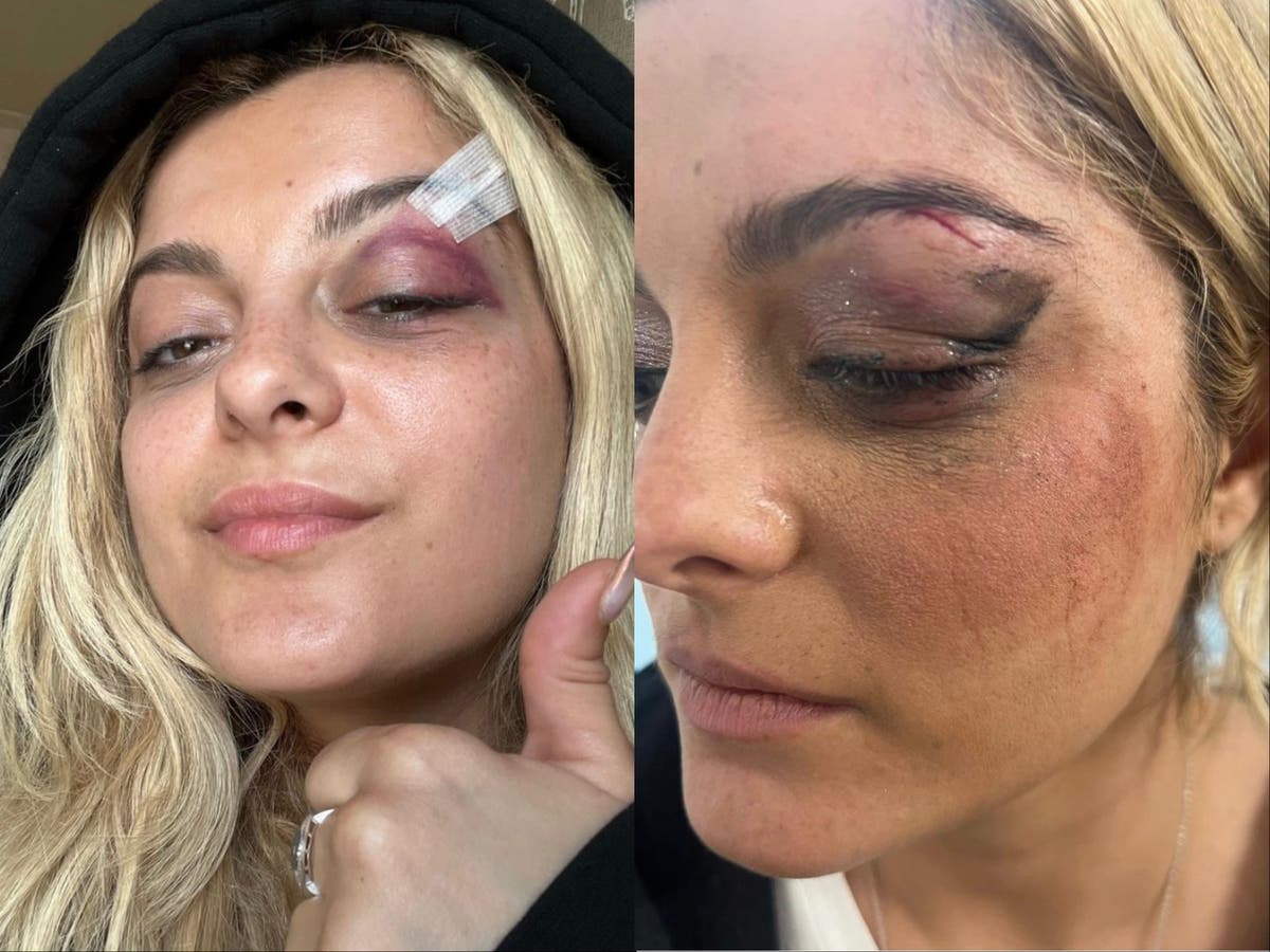 Bebe Rexha Hit by Phone During Concert, Suffers Injury.