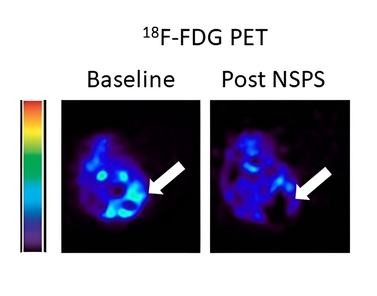 Featured image for "Hydroxyapatite-Targeting Nanodrug Halts Aggressive Breast Cancer Growth"