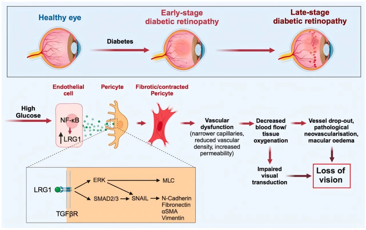 Featured image for New Insights into Early Detection and Impact of Diabetes on Eye Health
