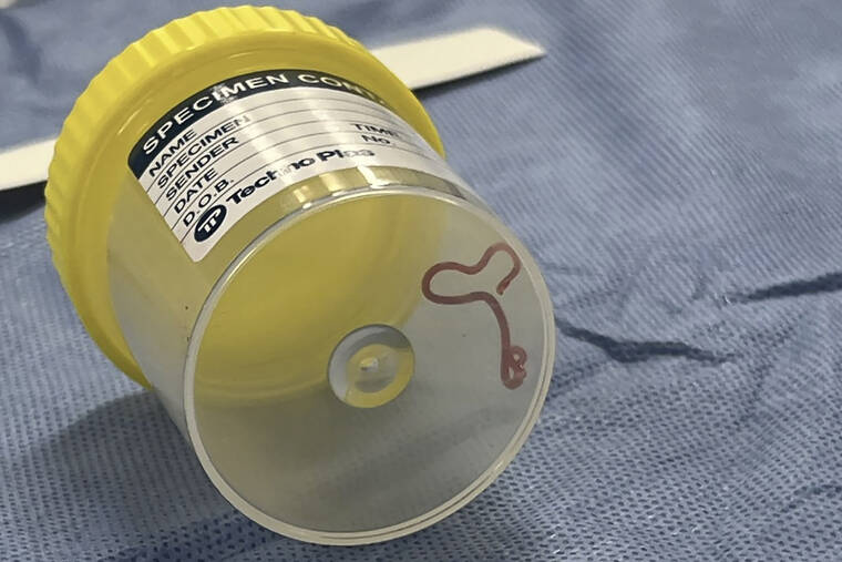 Australian Neurosurgeon Makes World-First Discovery: Live Worm Removed from Woman's Brain