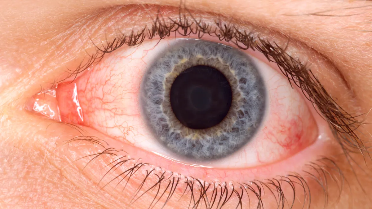 'Arcturus' Linked to New Itchy COVID Symptom in NY Area