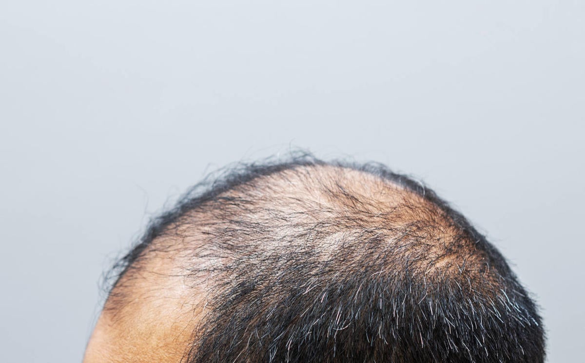 Featured image for Doctors Warn of Significant Problem: Shortage of Hair-Thinning Drug