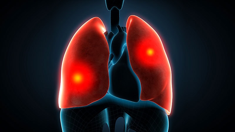 Featured image for Optimizing Treatment for Pulmonary Embolism and Afib with Catheter-Based Interventions.