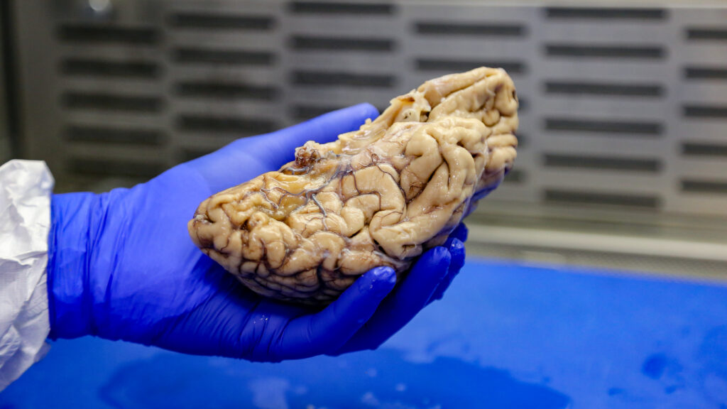 Featured image for Diversity in Black Brains Studied by Alzheimer's Scientist.