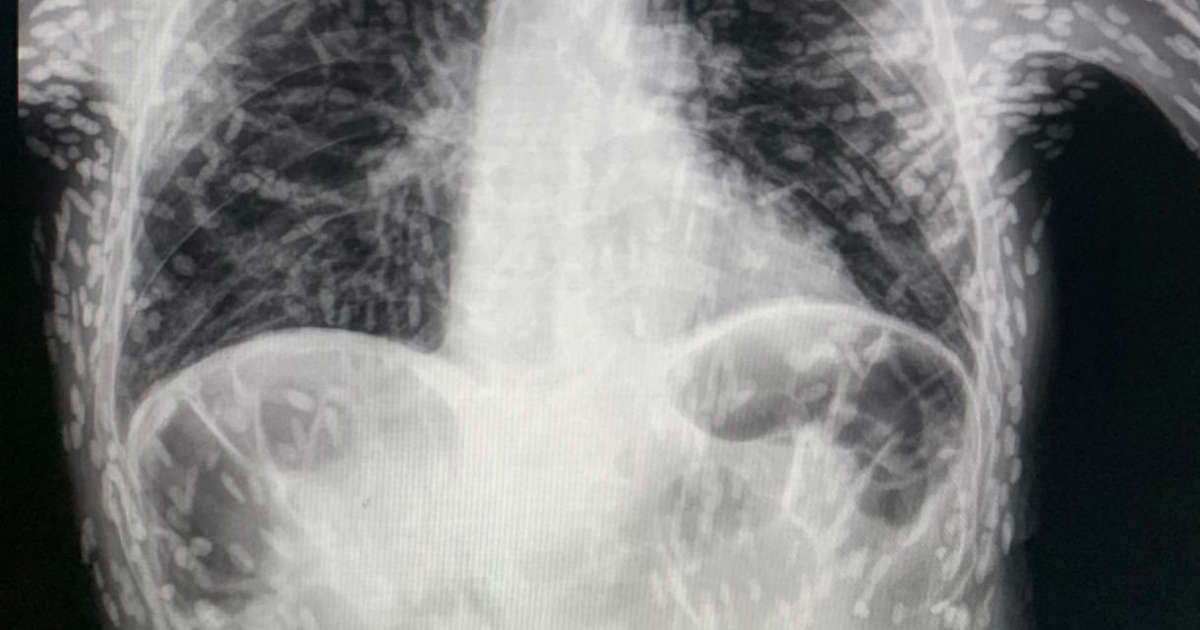 Featured image for Man's cough turns out to be tapeworm infestation