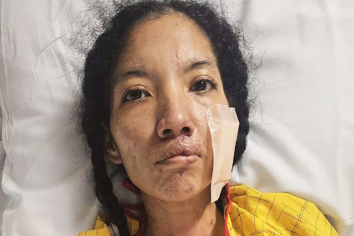 Featured image for Mother of Two with Autism Loses Limbs to Flesh-Eating Disease