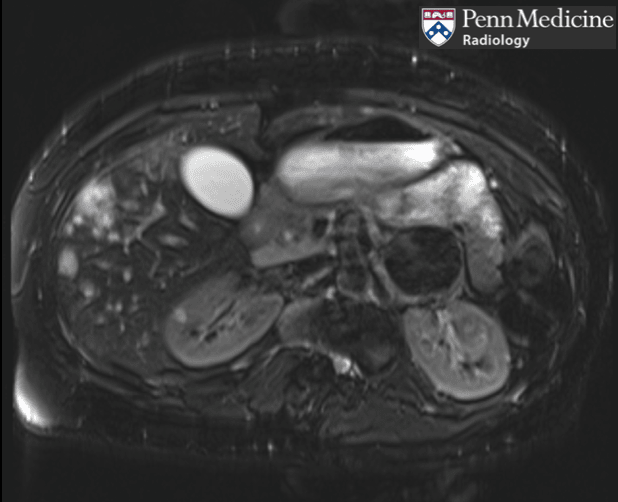 Featured image for "Uncovering the Unexpected: The Enigma of a 40-Year-Old Man's Incidental Adrenal Mass"