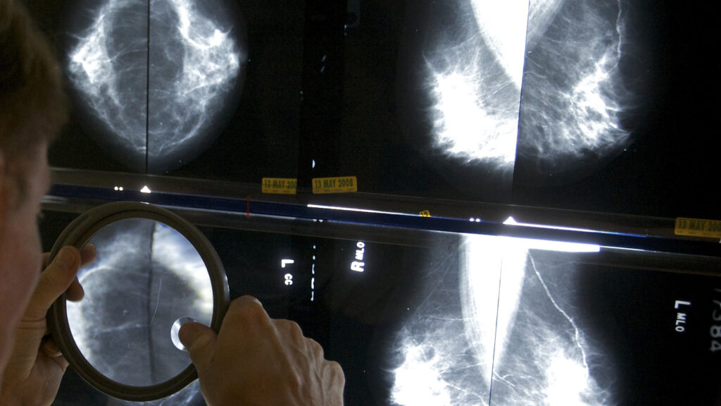 Featured image for AI Revolutionizes Breast Cancer Detection and Risk Prediction