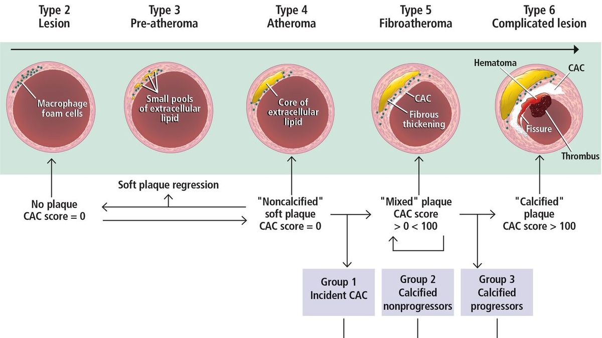 Featured image for "Understanding Coronary Calcium Scans for Heart Health"