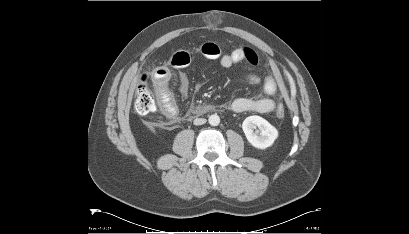 Featured image for "Revolutionary Single-Dose Gene Therapy Transforms Lives of Hereditary Angioedema Patients"