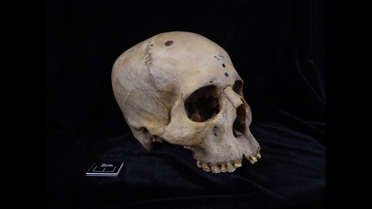 Ancient Egyptian Skull Reveals Early Cancer Treatment Efforts