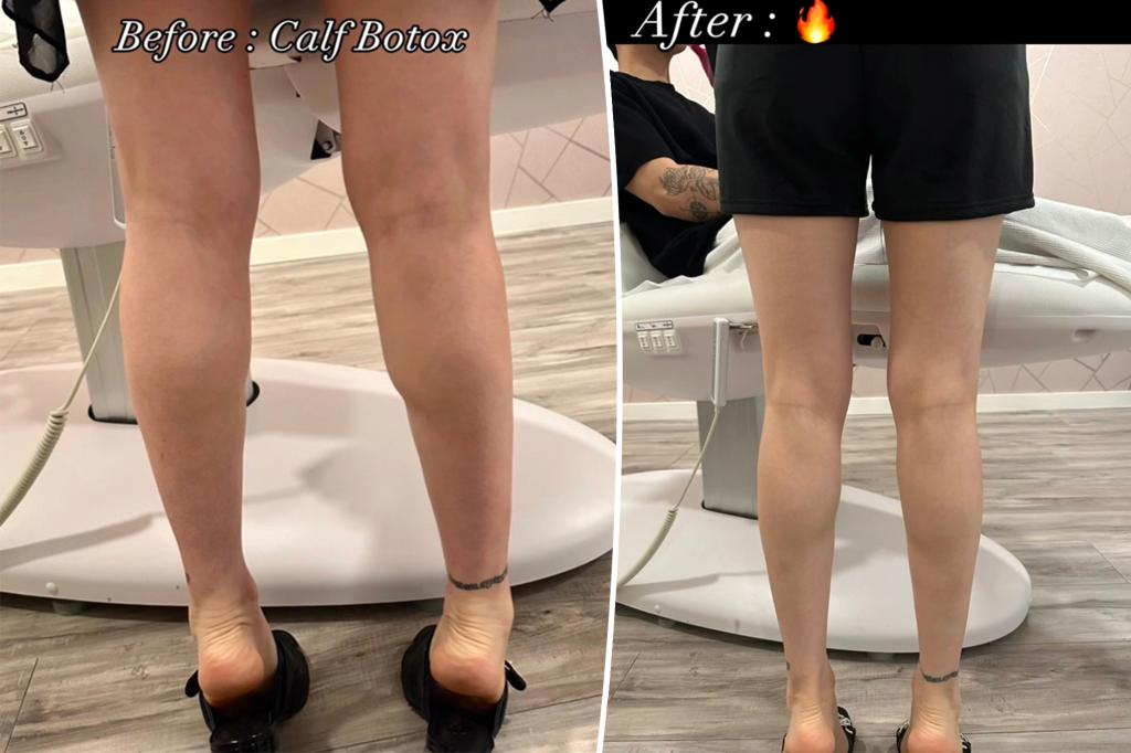 Featured image for "Calf Tox: The TikTok Slimming Fad Sweeping Social Media"