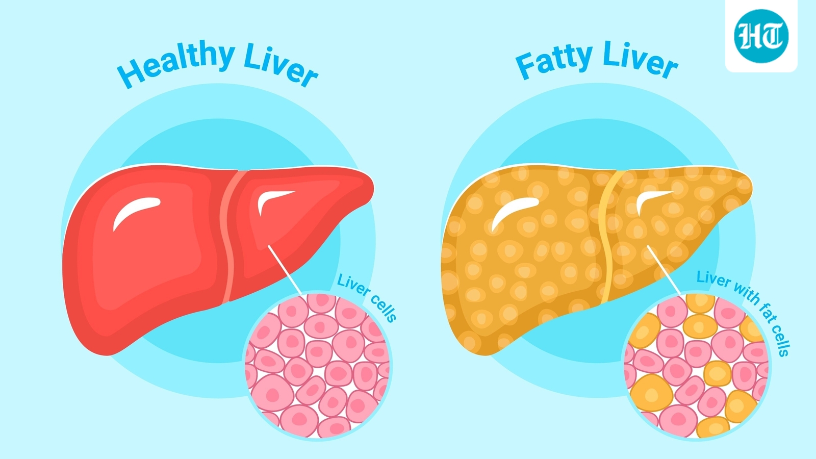 Featured image for Top Doctors Reveal Early Signs of Fatty Liver to Watch For