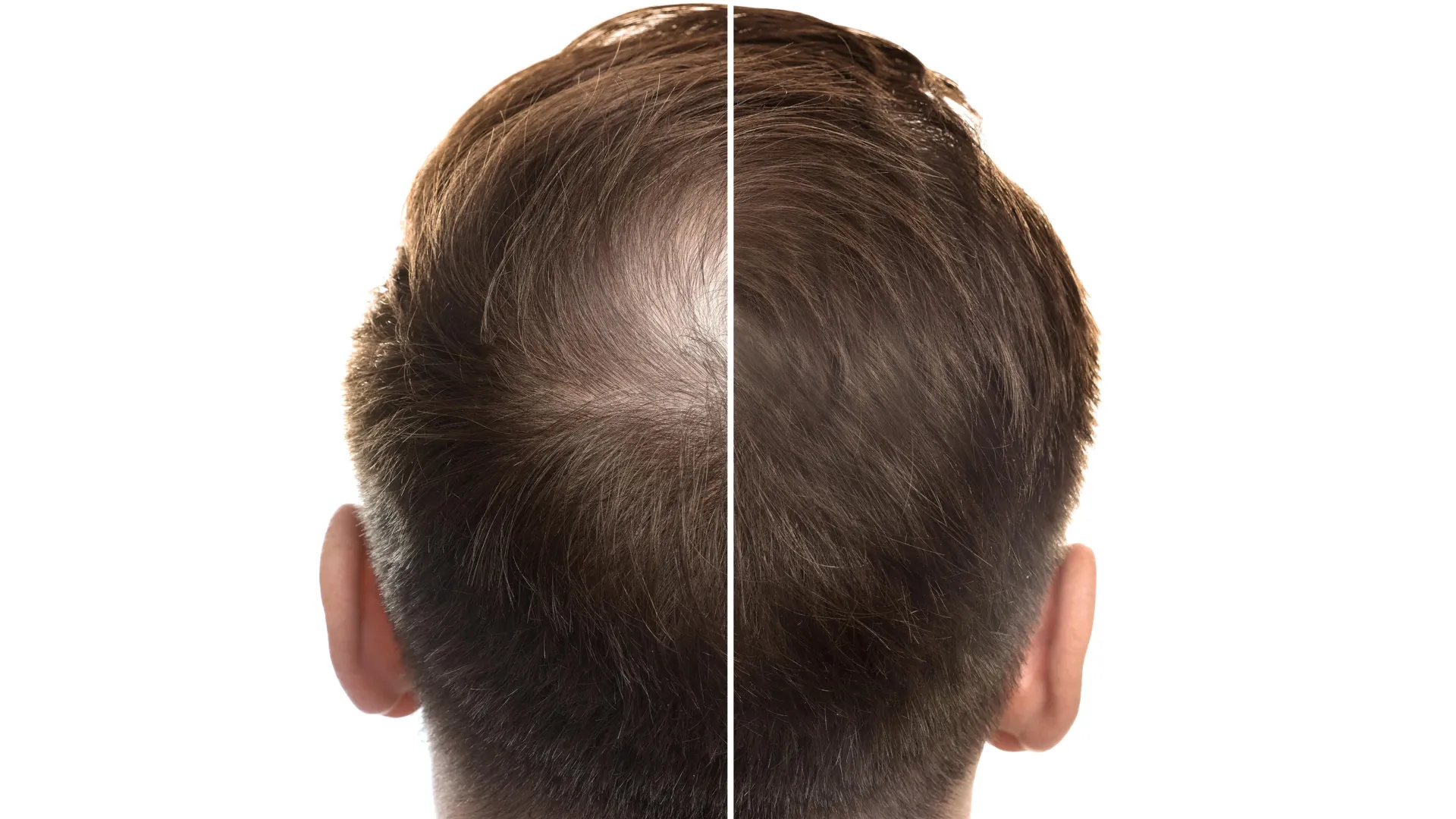 Featured image for Stevia Compound Promises New Hope for Hair Regrowth