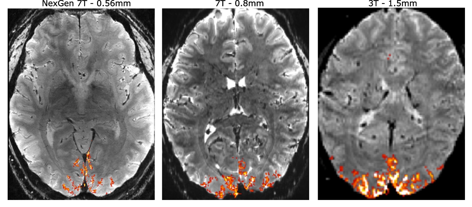 Featured image for Revolutionary Design Revolutionizes Functional MRI Brain Imaging with 10x Better Resolution