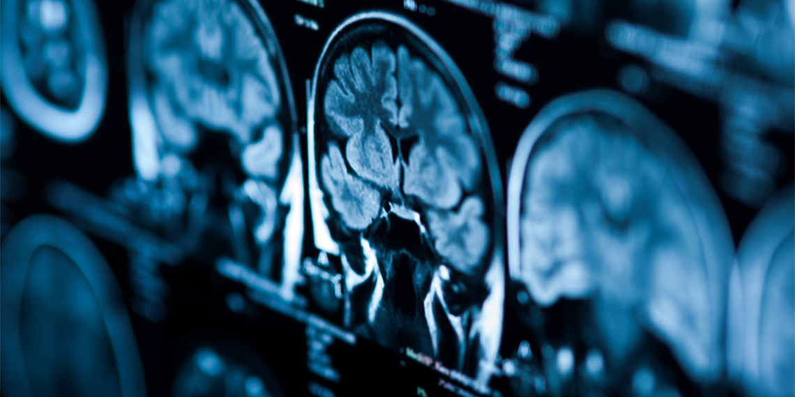 Featured image for Parental Criticism Trumps Praise in Impact on Depressed Teens, Brain Imaging Study Reveals