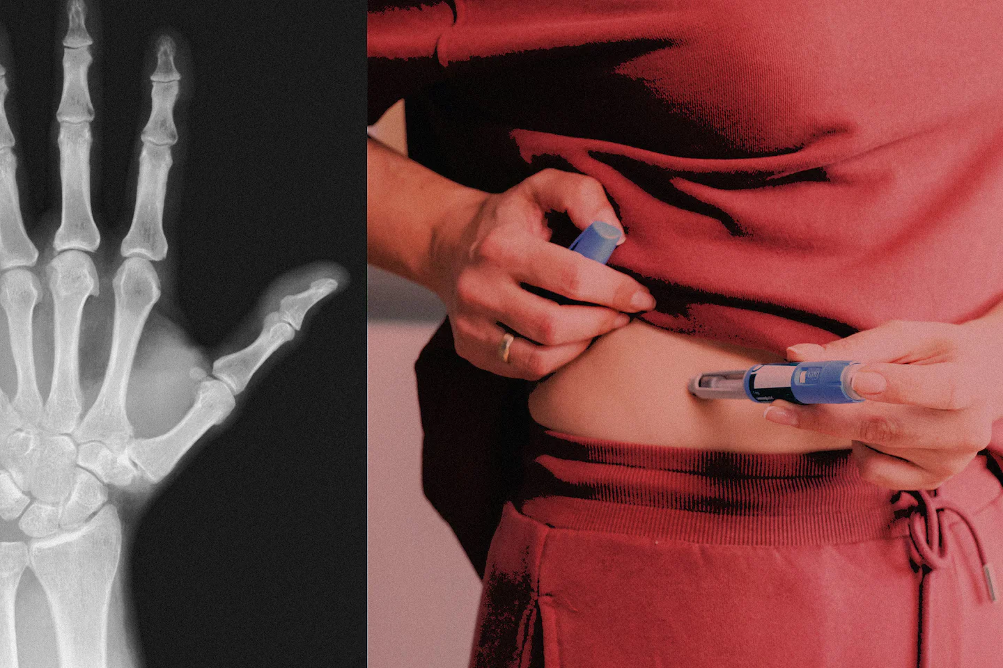 GLP-1 Weight-Loss Drugs May Elevate Bone and Tendon Injury Risk, Study Finds